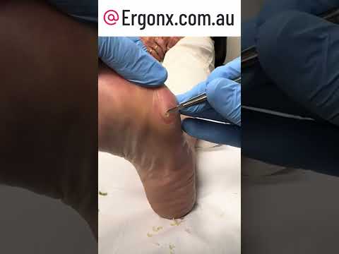 Say Goodbye to Painful Corns Expert Podiatrist Removal Unveiled #Podiatry #FootCare