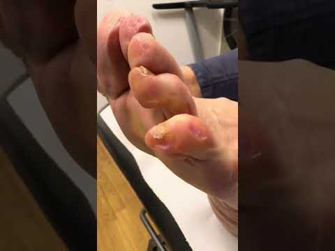 Amazing Little Toe Transformation Corn & Callus Removal by Podiatrist #FootCare #Podiatry