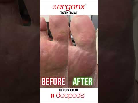 Bye-Bye Hard Skin: Big Toe Relief for Work & Safety Boot Users #FootCare #BootProblems