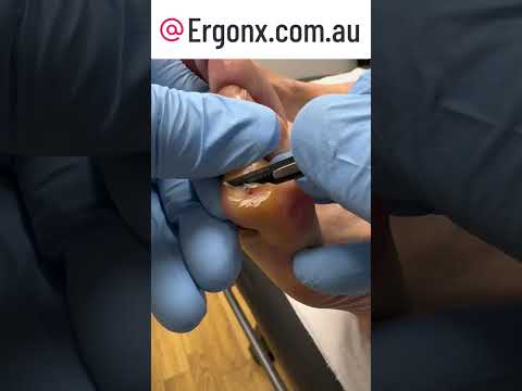 Say Goodbye to Little Toe Corns & Calluses in Our Podiatry Clinic #FootCare #Podiatry