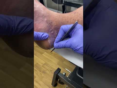 Say goodbye to stubborn calluses! 👋 Watch as this Aussie podiatrist works magic on tough heels