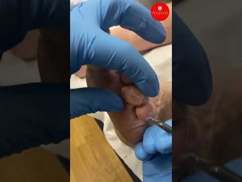 Painful Toes: Pressure, Footwear and Care Tips