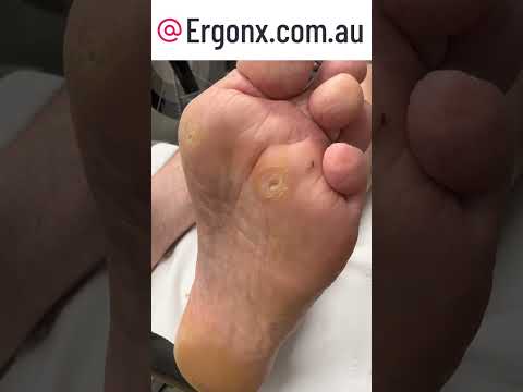 Satisfying Slow Motion Corn & Callus Removal by Podiatrist #FootCare #SatisfyingVideos