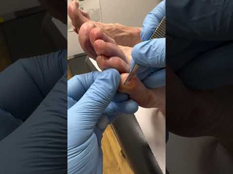 Satisfying Little Toe Callus Removal by Podiatrist #CallusCutting #Satisfying