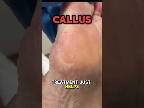 🦺 Hard-Working Tradie Callus 👣 Years of hard work on your feet can take their toll