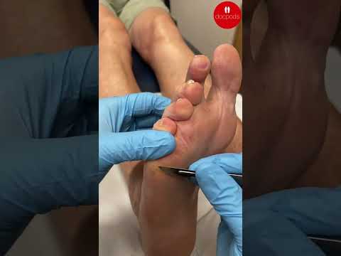 How Podiatrists Treat Ball of Foot Calluses