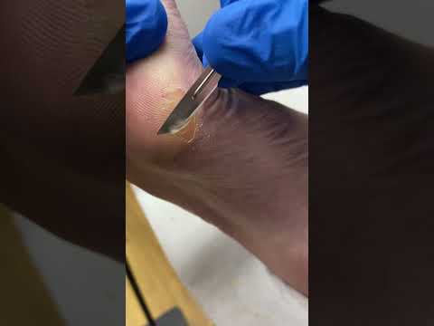 Transformative Bunion & Callus Removal by Expert Podiatrist #FootCare #Podiatry