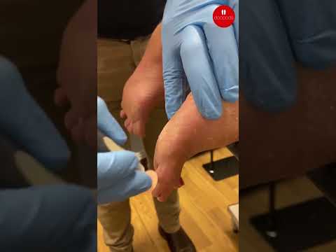 How Podiatrists Sand Rough Heels Smooth Safely