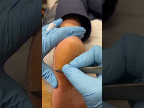Transform your feet with a callus-blasting makeover! Say goodbye to rough, cracked heels and hello