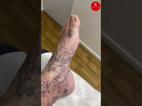 Discover the truth about varicose veins! 🌟 From symptoms to the best treatments, we're diving deep