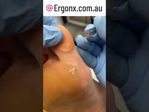 Satisfying Callus Removal at the Podiatry Clinic Big Toe Transformatio ...