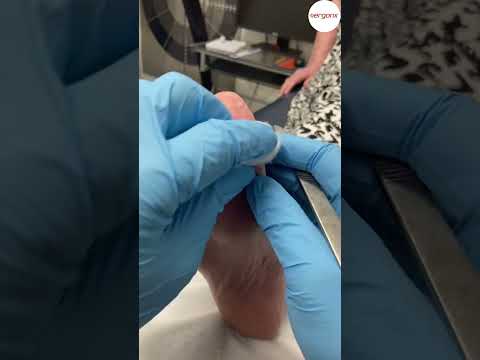 Satisfying Big Toe Callus Removal by Podiatrist #Podiatry #CallusCare