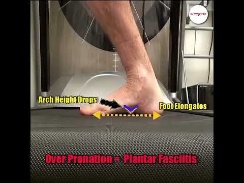 Understanding Overpronation and Plantar Fasciitis