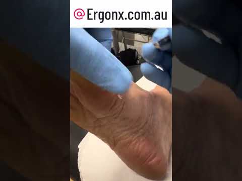 Watch a Podiatrist Remove a Thick Callus from Big Toe Joint with Scalpel #Podiatry #CallusRemoval