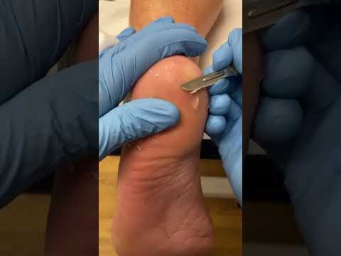 Say goodbye to those stubborn heel calluses! Watch as a skilled podiatrist works magic to remove