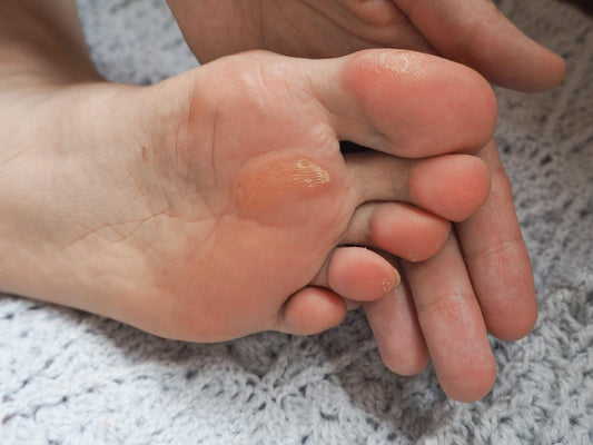 Satisfying Corn Removal from Heel by Podiatrist