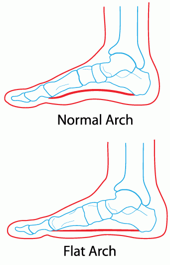 When our foot rolls in too far (excessive pronation) our arch can lower from a high arch to a low arch.  This causes strain on the foot and can lead to plantar fasciitis